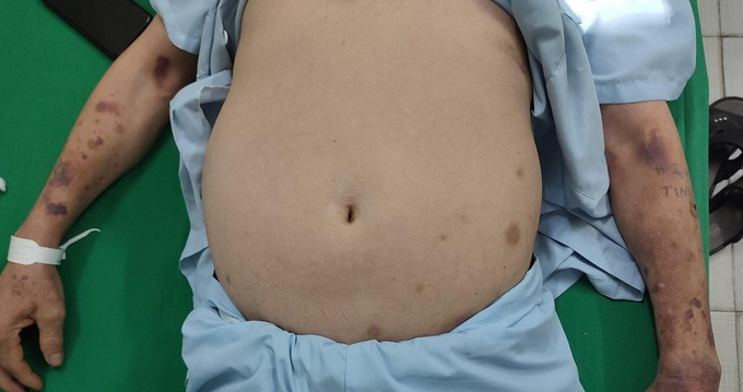 Lạm dụng corticoid gây ra những tác dụng phụ nguy hiểm khôn lường