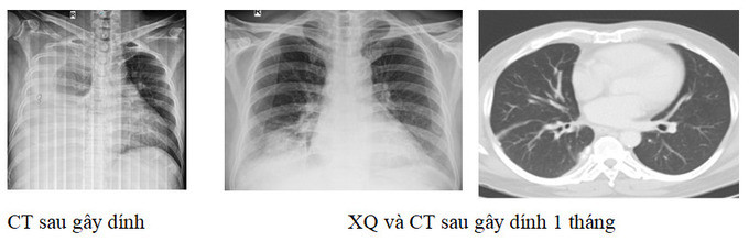 Phú Thọ sử dụng phương pháp gây dính màng phổi bằng bột talc điều trị tràn dịch màng phổi tái diễn