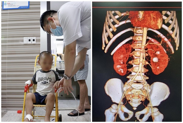 Bệnh viện Đa khoa Hùng Vương phẫu thuật tán sỏi qua da bằng đường hầm nhỏ cho bệnh nhi 3 tuổi bị sỏi thận 2 bên