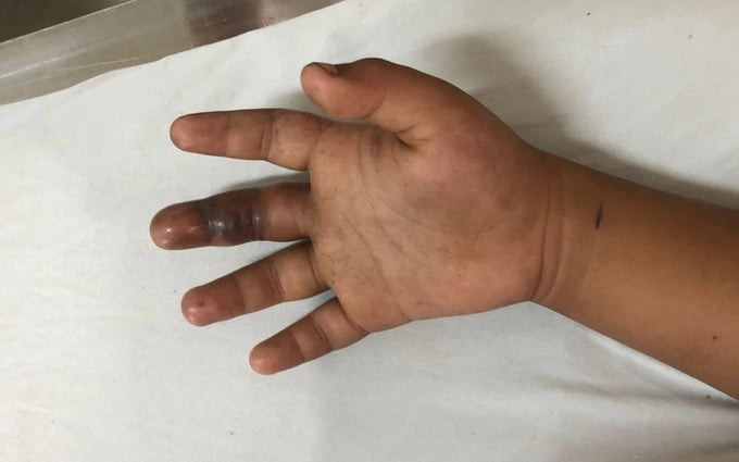 Bệnh viện Việt Nam - Thụy Điển Uông Bí tiếp nhận và điều trị cho 4 bệnh nhi bị rắn cắn với các triệu chứng từ nhẹ đến nặng