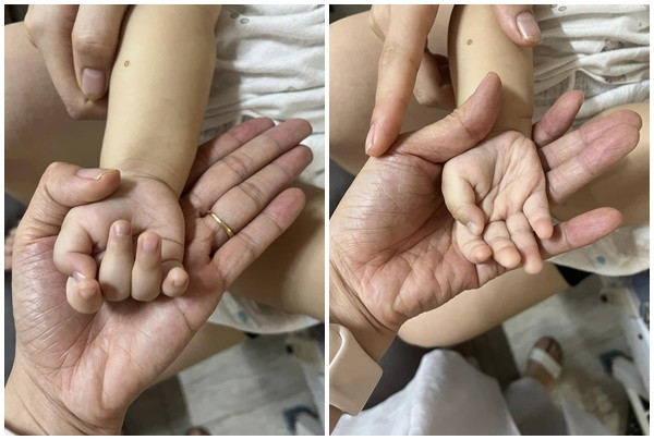 Phú Thọ: Bé trai 7 tháng phải nhập viện truyền máu với biểu hiện xanh xao, 22h đêm mới chịu ngủ
