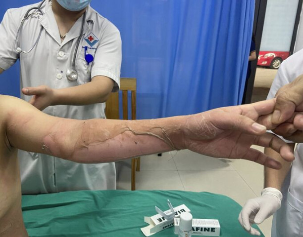 Phú Thọ: Bệnh viện Đa khoa Hùng Vương cấp cứu bệnh nhân bị bỏng cồn
