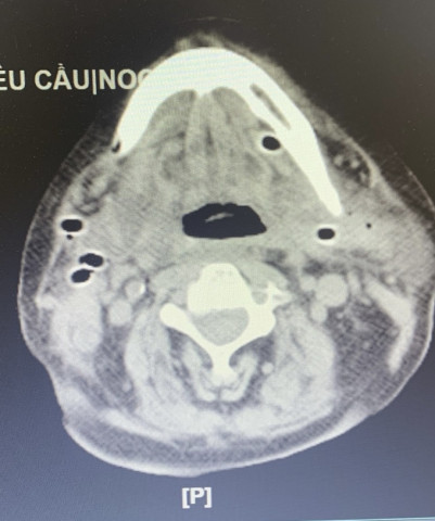 Bệnh viện Hữu nghị Việt Đức phẫu thuật cấp cứu ca bệnh đặc biệt bị viêm tấy sàn miệng lan tỏa