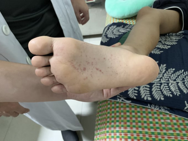 Nghệ An tiếp nhận trường hợp bé gái 9 tuổi mắc bệnh Ban xuất huyết Schonlein-Henoch