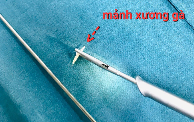 Bệnh viện Đa khoa tỉnh Phú Yên gắp dị vật là mảnh xương cá trong thực quản bệnh nhi 25 tháng tuổi