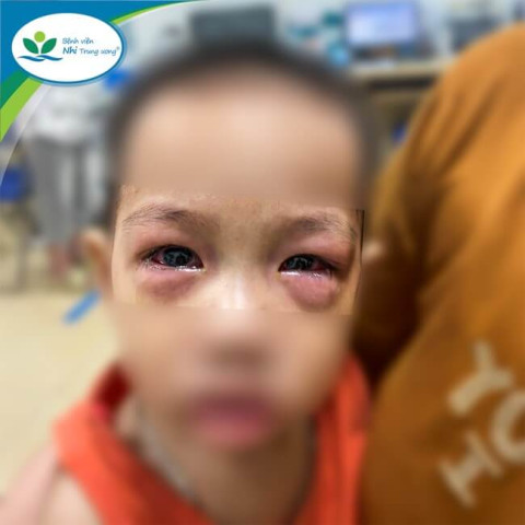 Bệnh viện Nhi Trung ương tiếp nhận gần 50 ca bệnh nhi mắc viêm kết mạc cấp trong vòng 1 tháng