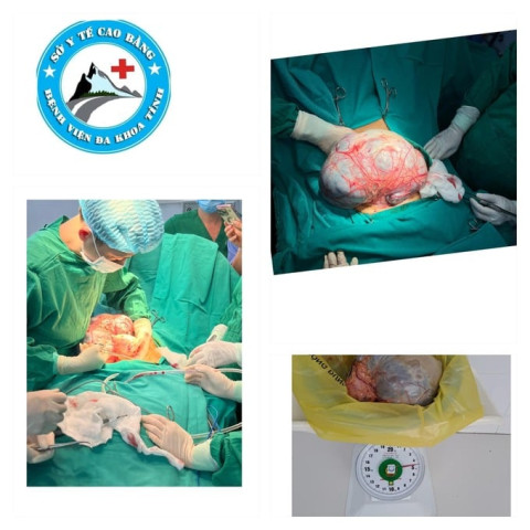 Bệnh viện Đa khoa tỉnh Cao Bằng phẫu thuật lấy khối u khổng lồ nặng 4,5 kg cho 1 bệnh nhân nữ