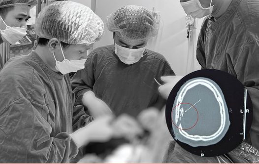 Vĩnh Phúc: Bệnh viện Hữu nghị Lạc Việt phẫu thuật cho bệnh nhân bị thanh sắt rơi xuyên qua sọ