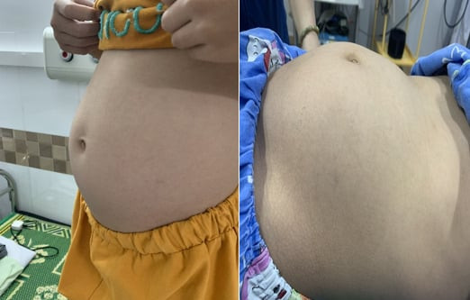 Bệnh viện Trẻ em Hải Phòng phẫu thuật thành công cắt bỏ khối u buồng trứng nặng hơn 6 kg cho bé gái 9 tuổi