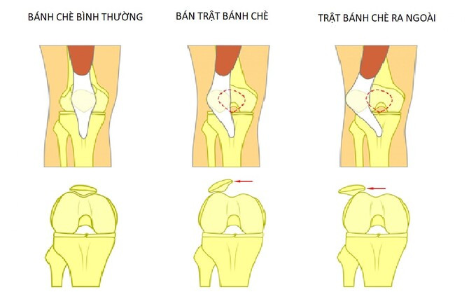 Phẫu thuật, điều trị trật bánh chè sau chấn thương