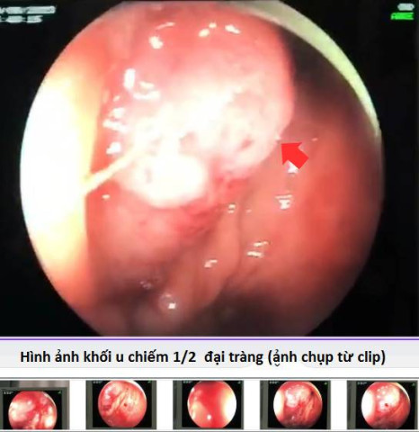 Phú Thọ: Trung tâm Y tế huyện Cẩm Khê phẫu thuật khối u sùi loét tại đại tràng cho nam bệnh nhân 17 tuổi