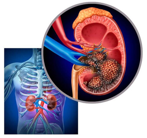 Bài thuốc hỗ trợ điều trị ung thư thận