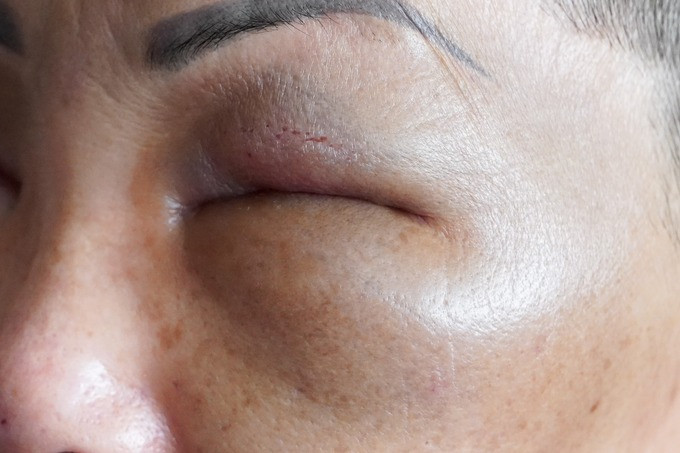 Bị lừa tiêm filler giá rẻ ở nhà nghỉ, bệnh nhân bị biến chứng và mất sạch tài sản