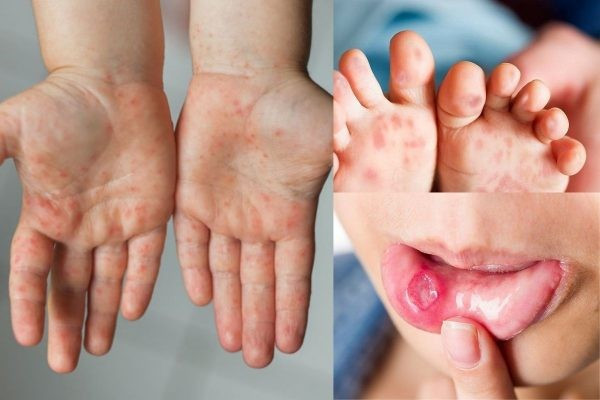 TPHCM: Số ca sốt xuất huyết và tay chân miệng giảm mạnh