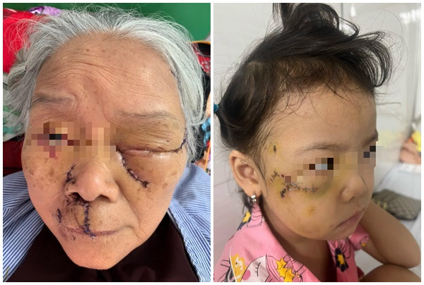 Bệnh viện Đa khoa tỉnh Bắc Giang tiếp nhận nhiều trường hợp bị chó cắn gây tổn thương vùng mặt rất nguy hiểm