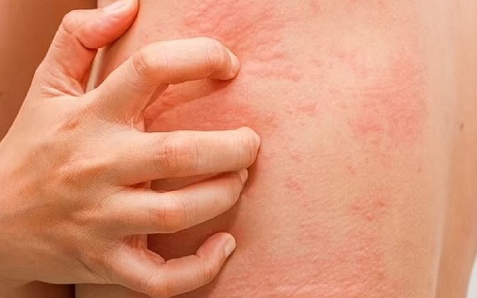 Hải Phòng: Bệnh viện Hữu nghị Việt Tiệp điều trị nhiều trường hợp phản vệ do thức ăn