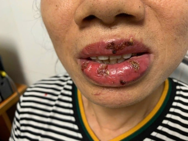 Bệnh viện Đa khoa tỉnh Phú Thọ tiếp nhận 1 bệnh nhân bị viêm da nhiễm trùng do xăm môi