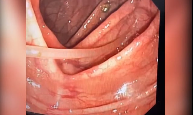 Một nữ bệnh nhân 40 tuổi phát hiện ký sinh trùng ở đại tràng khi đi khám sức khỏe định kỳ