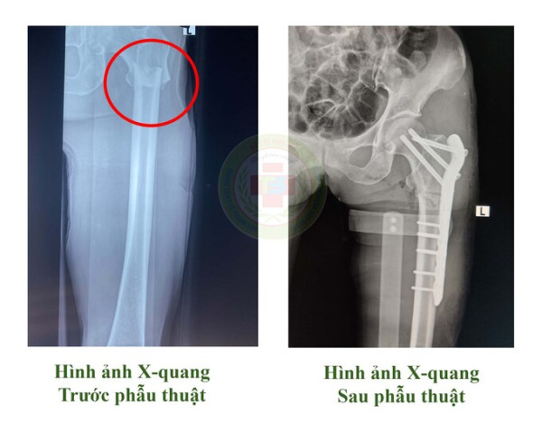 Phú Thọ: Trung tâm Y tế huyện Thanh Sơn cấp cứu trường hợp bị trâu húc khiến gãy xương đùi