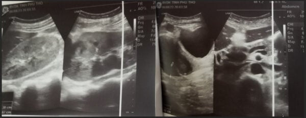 Bệnh viện Đa khoa tỉnh Phú Thọ điều trị cho người bệnh viêm ruột thừa cấp, phát hiện suy thận, phải lọc máu cấp cứu