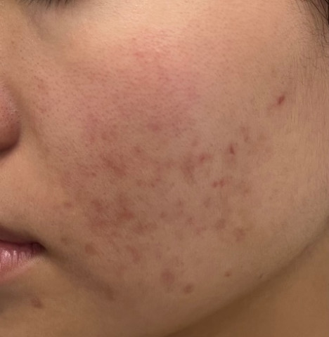 Chuyên gia khuyến cáo không nên thực hiện peel da tại nhà