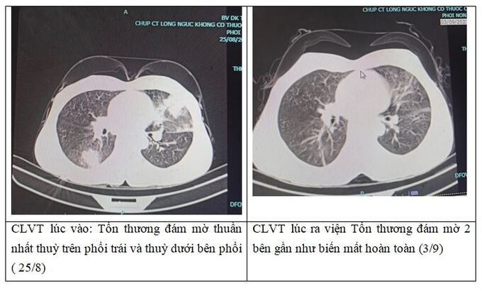 Bệnh viện Đa khoa tỉnh Phú Thọ tiếp nhận 1 nữ bệnh nhân mắc viêm phổi tăng bạch cầu ái toan, không có biểu hiện triệu chứng rõ ràng
