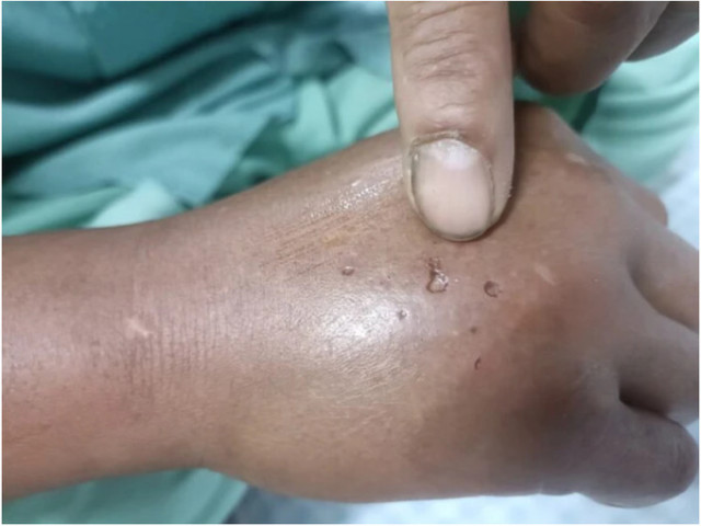 Bệnh viện Đa khoa tỉnh Phú Thọ tiếp nhận 3 trường hợp bị rắn độc cắn ngay tại nhà