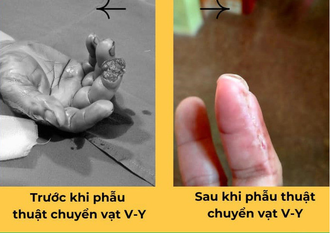 Nghệ An: Bệnh Viện Đa Khoa An Phát phẫu thuật thành công cho bệnh nhân 57 tuổi bị máy cắt cỏ cắt ngón thứ 3
