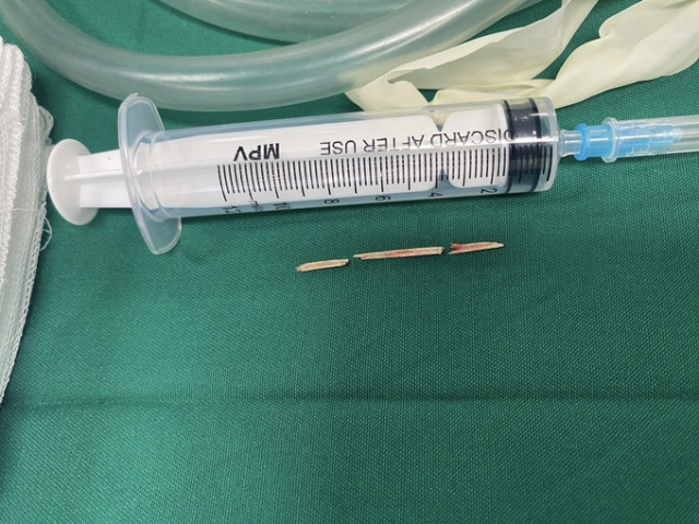 Hà Nội: Bệnh viện Hữu nghị Việt Đức cấp cứu nữ bệnh nhân do tăm nhọn đâm thủng dạ dày