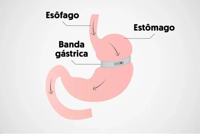 Tìm hiểu về phẫu thuật giảm béo