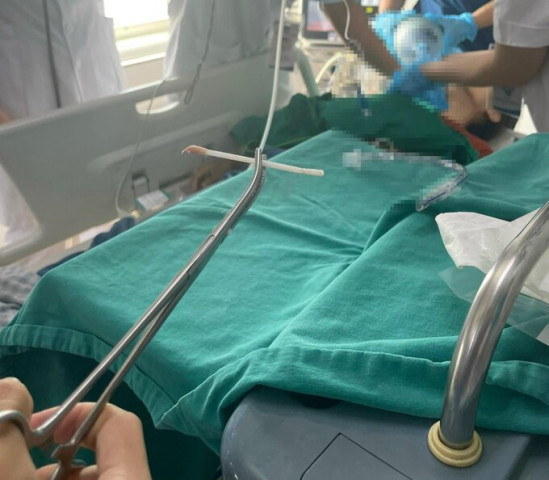 Bệnh viện Đa khoa tỉnh Phú Thọ tiếp nhận bệnh nhân 34 tuổi nguy kịch do tăm bông mắc tại khí quản