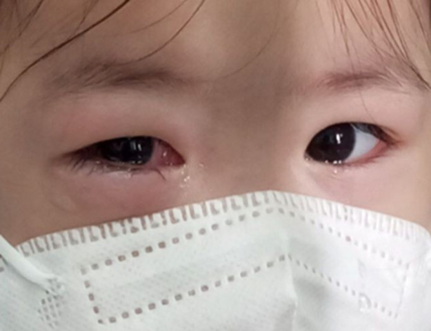 Bác sĩ khuyên những việc cần làm để phòng bệnh đau mắt đỏ cho trẻ mầm non