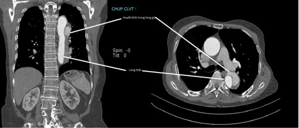 Bệnh viện Đa khoa tỉnh Phú Thọ đặt Stent Graft điều trị thành công bệnh nhân 77 tuổi bị phình tách động mạch chủ