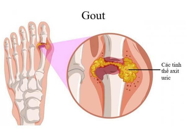 Bộ phận trong cơ thể dễ tổn thương do axit uric cao