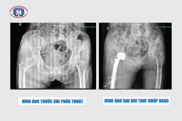 Bệnh viện Đa khoa tỉnh Phú Thọ thực hiện phẫu thuật thay khớp háng cho bệnh nhân 75 tuổi