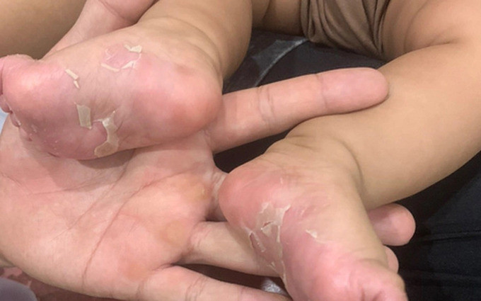 Bệnh viện Da liễu Trung ương điều trị cho bệnh nhi 3 tháng tuổi mắc giang mai do lây từ mẹ