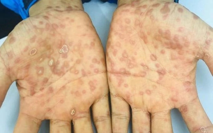 Bệnh viện Da liễu Trung ương điều trị nam bệnh nhân mắc giang mai sau hơn 2 tháng quan hệ tình dục không an toàn