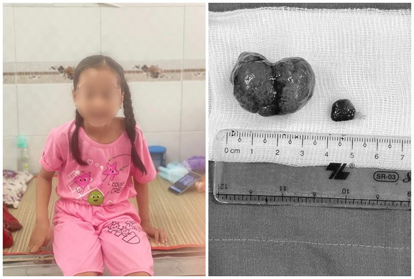 Bệnh viện Nhi đồng Cần Thơ điều trị thành công trường hợp bệnh nhi lồng ruột do polyp đại tràng