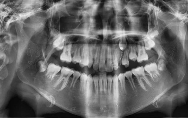 Nam thanh niên 16 tuổi bị viêm lợi, vào viện khám phát hiện u máu ác tính