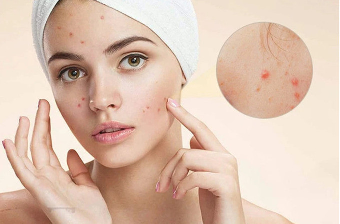 7 nguyên tắc để trị mụn hiệu quả