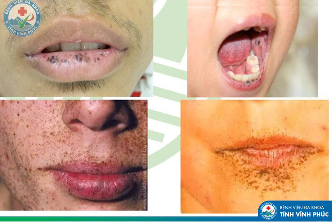 Bệnh viện Đa khoa tỉnh Vĩnh Phúc tiếp nhận 1 trường hợp bệnh nhi 8 tuổi mắc hội chứng Peutz Jeghers