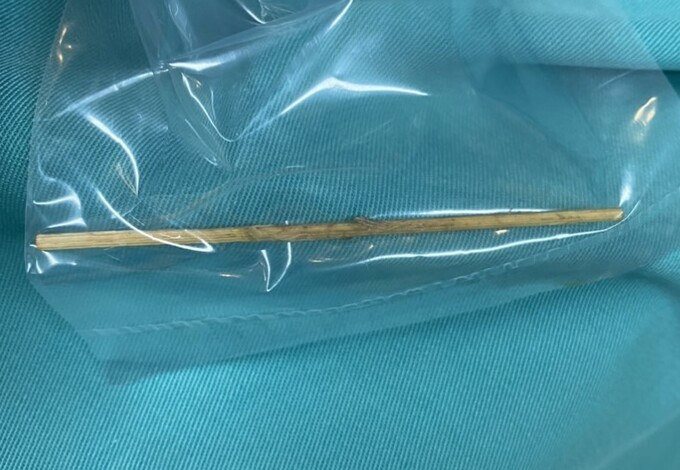 Bệnh viện Đa khoa tỉnh Phú Thọ cấp cứu người đàn ông có chiếc tăm tre dài 10 cm đâm thủng đại tràng