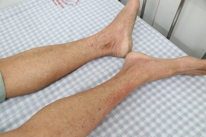 Bệnh viện Đa khoa tỉnh Phú Thọ gia tăng bệnh nhân nhập viện điều trị do mắc sốt xuất huyết
