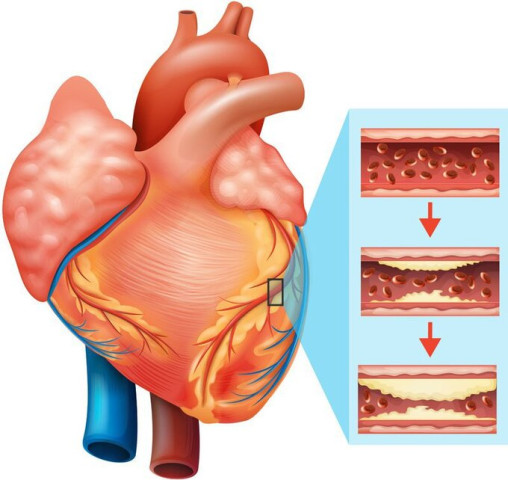 Bài thuốc điều trị bệnh động mạch vành