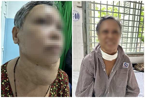 TP. Hồ Chí Minh: Bệnh viện Nhân dân Gia Định phẫu thuật thành công cho bệnh nhân có khối u tuyến giáp khổng lồ đeo bám suốt 30 năm
