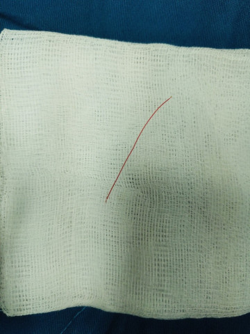 Bệnh viện Sản Nhi tỉnh Quảng Ngãi phẫu thuật thành công trường hợp dị vật đâm thủng ruột non cho bệnh nhi 7 tuổi