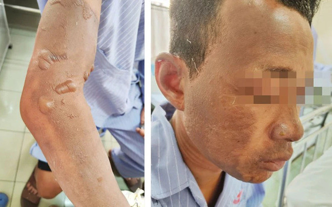Quảng Ninh: Bệnh viện Việt Nam - Thụy Điển Uông Bí tiếp nhận và điều trị cho 1 trường hợp bị bỏng nhiều vị trí trên cơ thể
