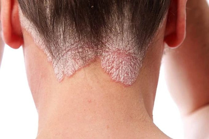 Những lưu ý để phòng ngừa tái phát bệnh vảy nến