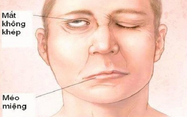 Bài thuốc điều trị bệnh liệt dây thần kinh số 7