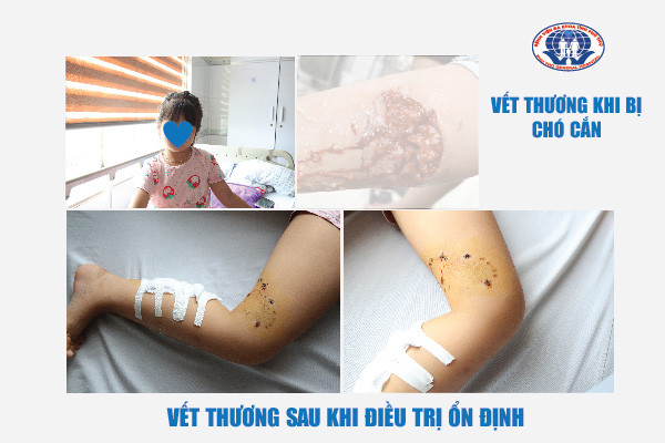 Bệnh viện Đa khoa tỉnh Phú Thọ tiếp nhận cùng lúc 2 trẻ bị nhiễm trùng do tụ cầu vàng sau khi bị chó cắn